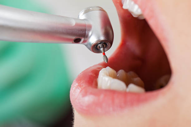 Best Emergency Wisdom Teeth Removal in Norristown, PA